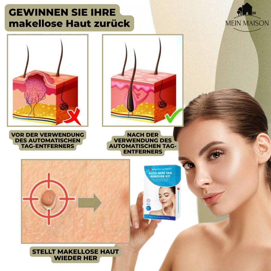 DermaLinx Wart Remover | Pain-Free Removal of Warts & Moles | For Home Use | No Surgery