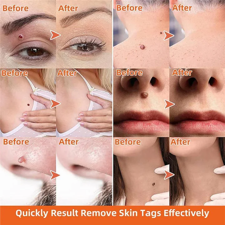 DermaClear Skin Tag Remover | Pain-Free Application | Compact & Hygienic | For Men & Women